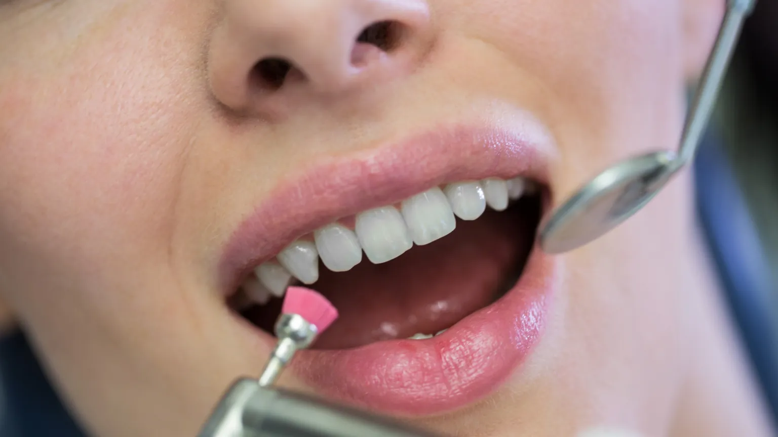 Teeth Whitening